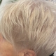 Thinning hair